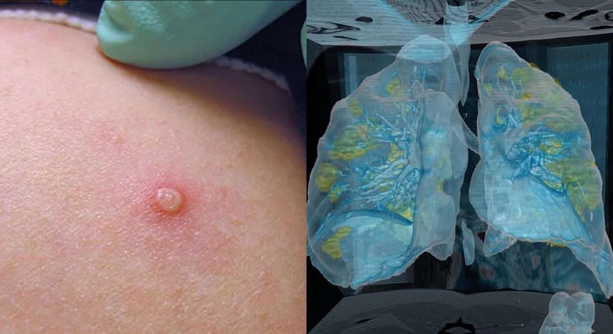 ¿Qué tan rápido se puede propagar la Viruela del Mono a comparación del Covid-19?