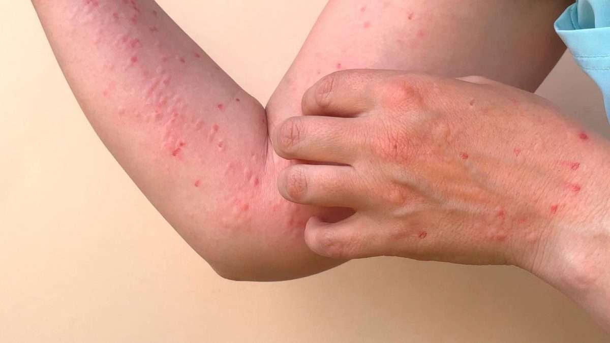 Ministerio de Salud reporta hasta este 21 de octubre 71 casos de Viruela del Mono en Guatemala