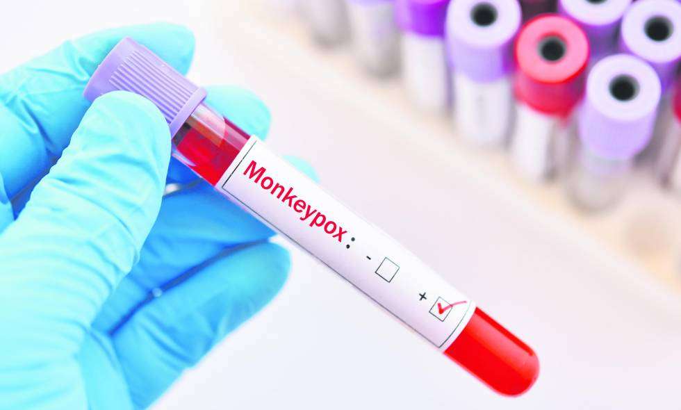 Suman 15 casos de viruela del mono en Guatemala