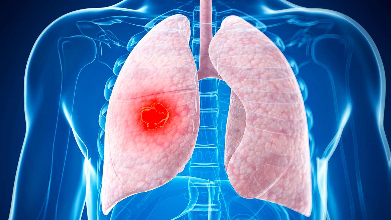 cáncer-de-pulmón