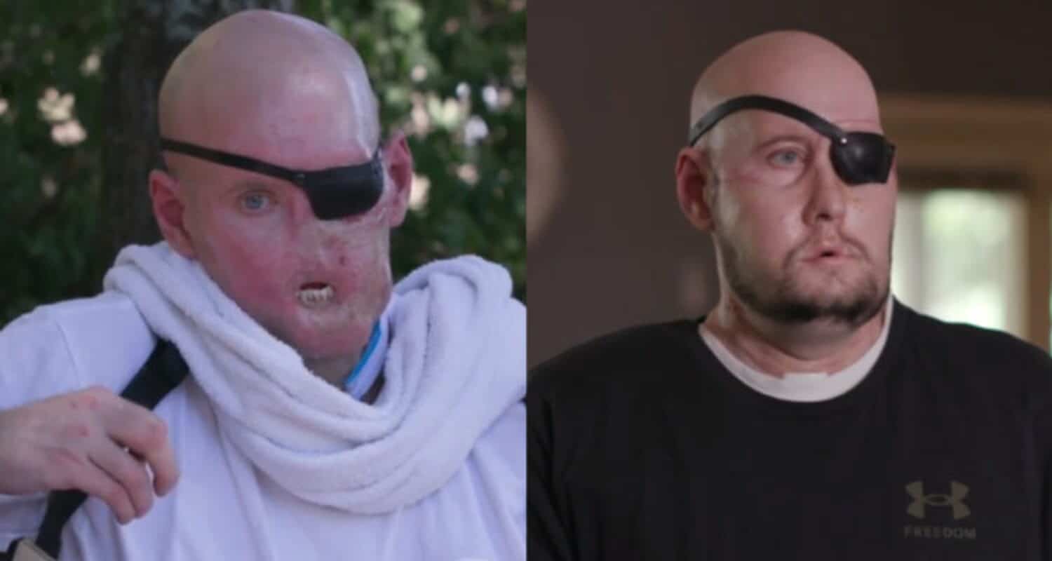 trasplante de ojo completo.