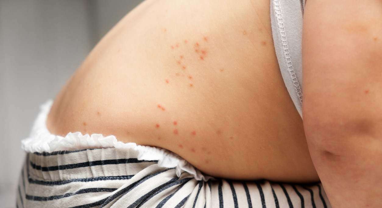 Casos de sarampión encienden alertas sanitarias y activan acciones de control