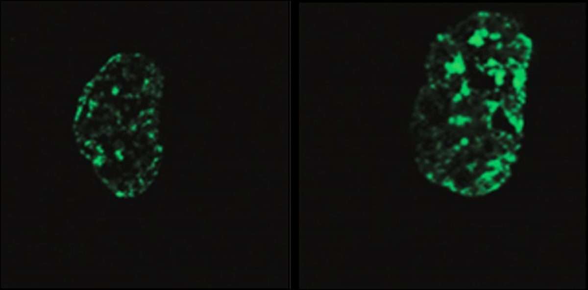 Imagen de la izquierda: célula del síndrome de progeria de Hutchinson-Gilford con signos de envejecimiento prematuro. Imagen de la derecha: la célula muestra menos signos de envejecimiento cuando el ARN LINE-1 está reducido y hay más proteína histona presente. EFE/Instituto Salk.SOLO USO EDITORIAL.