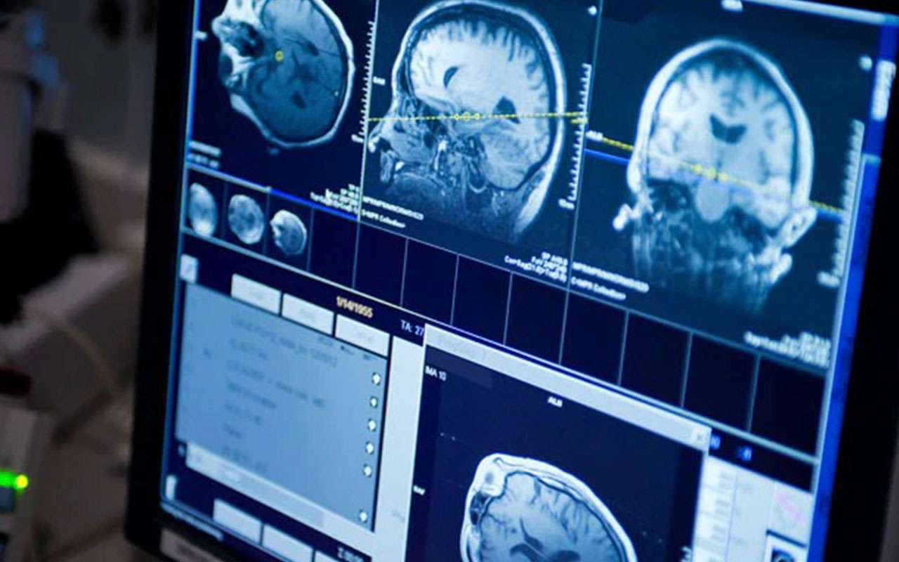 Una herramienta de IA puede analizar el ADN del cáncer cerebral en cirugía